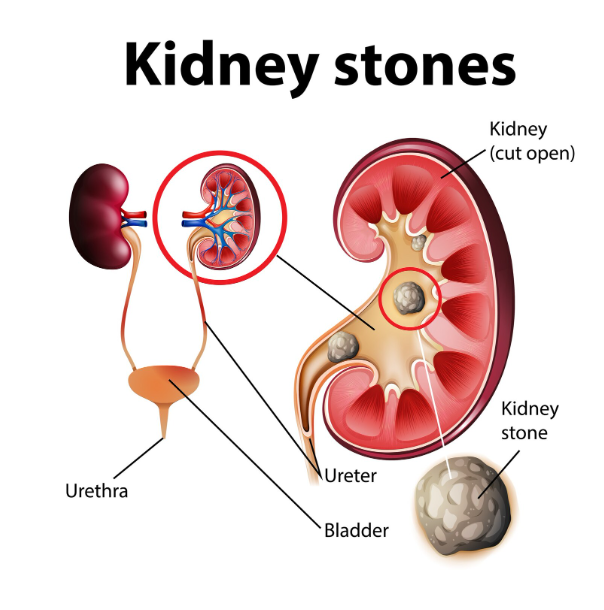 kidney stone with dr amir khan