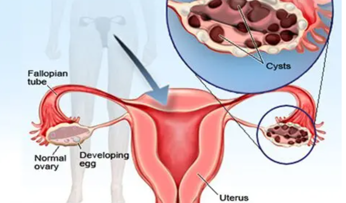 Cyst infertility dr amir khan