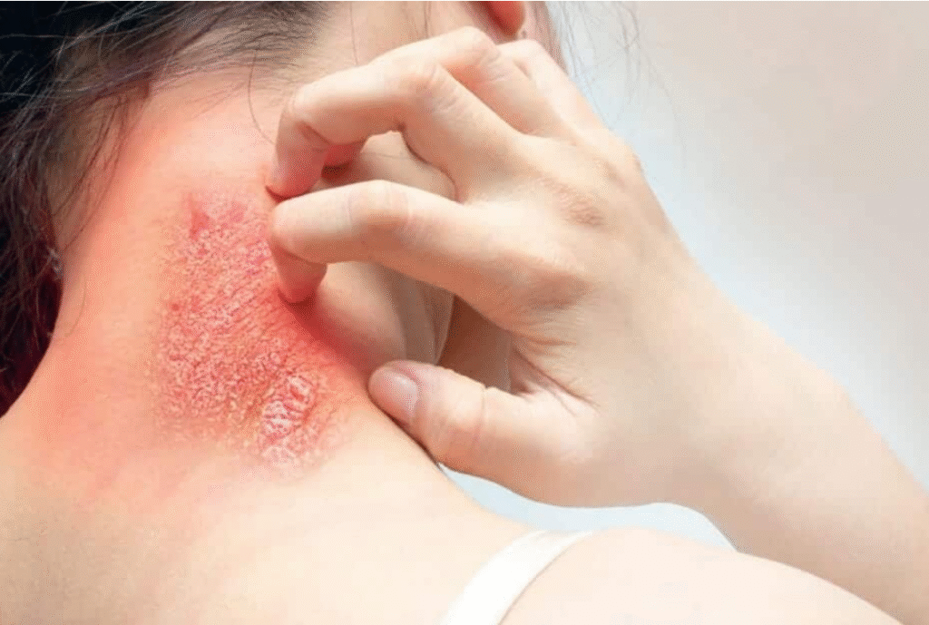 Fungal infection with dr amir khan